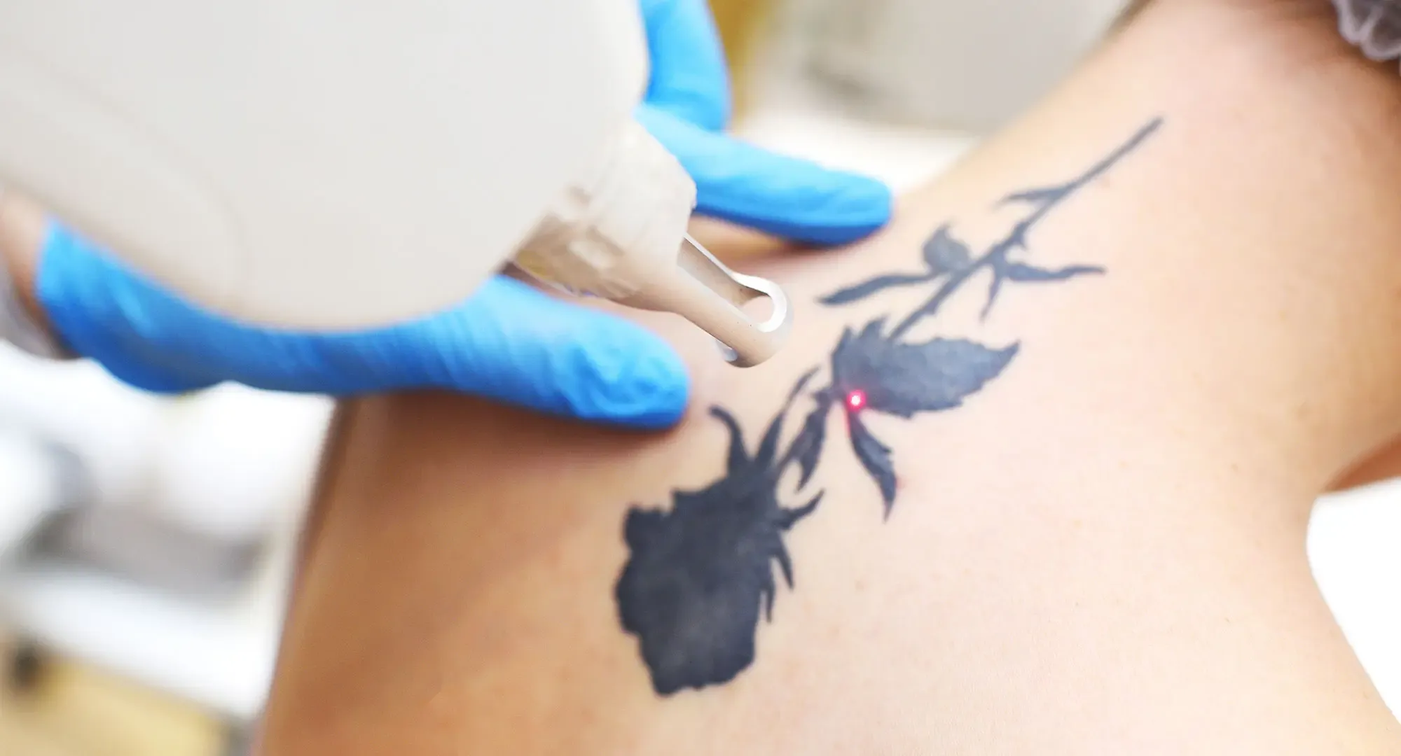 Détatouage laser à Metz