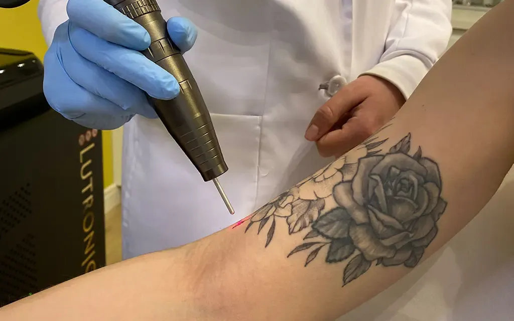 Qui peut réaliser un détatouage à Metz