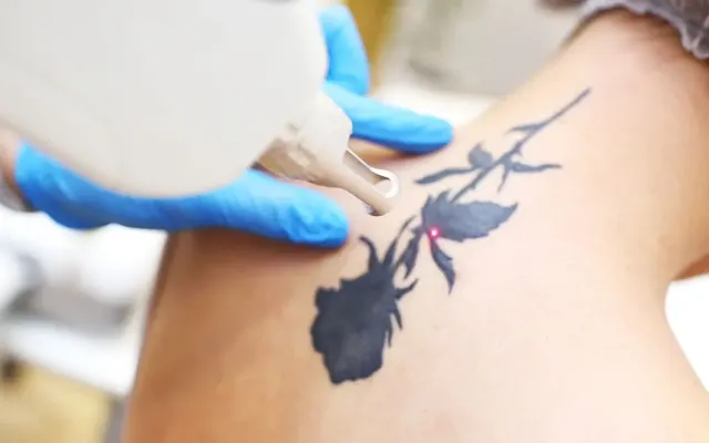 Eclaircissement pour un cover, retouche d’un tatouage
