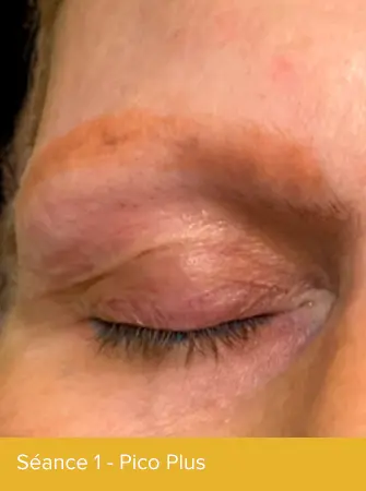 Détatouage sourcil - Pico plus - Metz - Luxembourg