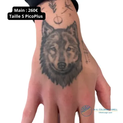 Tatouage main taille s - Laser Pico Plus - Metz et Luxembourg
