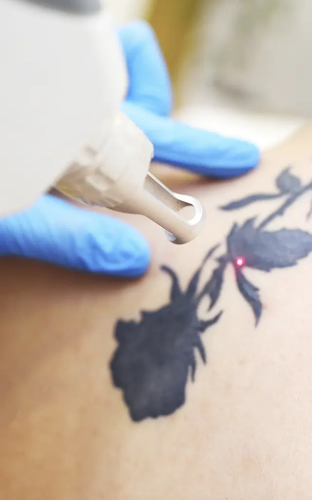 Eclaircissement tatouage pour un cover à Metz